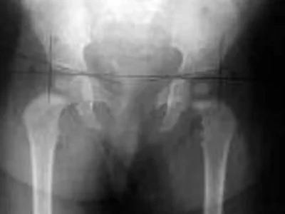 Brazil court limits SUS reimbursement for $47K surgery